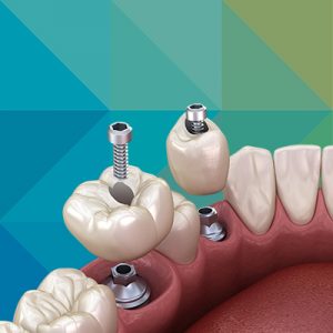 zubni implanti novi sad